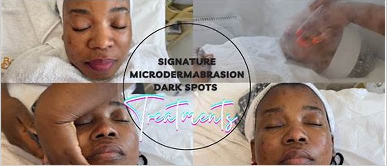 Microdermabrasion for dark spots